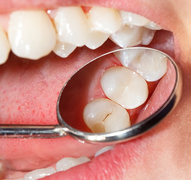Tooth Coloured Match Fillings | Harmony Family Dental Care | Springbank General and Family Dentist