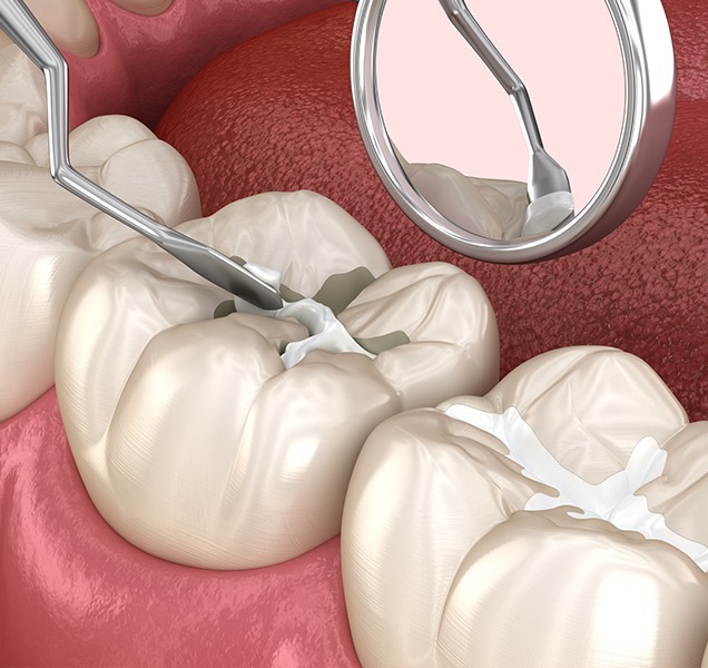 What are tooth Coloured Match Fillings | Harmony Family Dental Care | Springbank General and Family Dentist