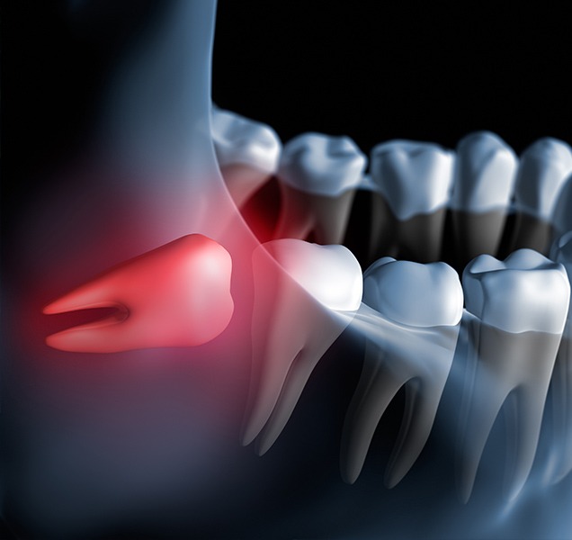 What are wisdom teeth extraction | Harmony Family Dental Care | Springbank General and Family Dentist