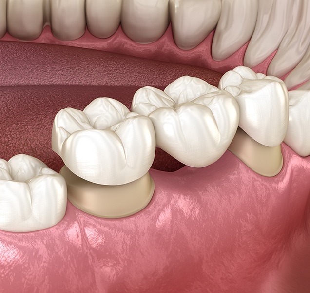 What is a dental bridge | Harmony Family Dental Care | Springbank General and Family Dentist