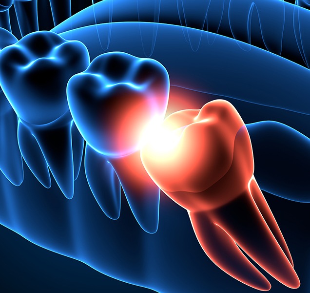 Wisdom Teeth Extraction | Harmony Family Dental Care | Springbank General and Family Dentist