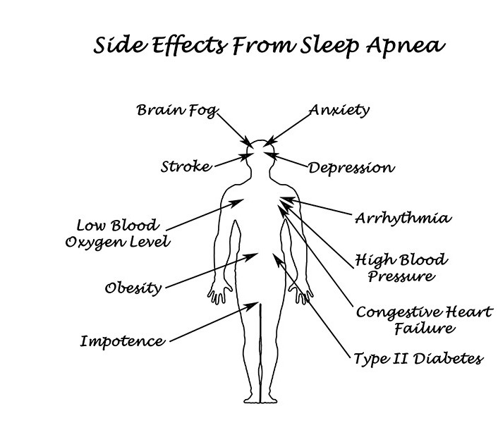 Symptoms of Sleep Apnea | Harmony Family Dental Care | Springbank General and Family Dentist