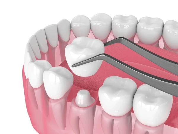 dental crowns in harmony, ab