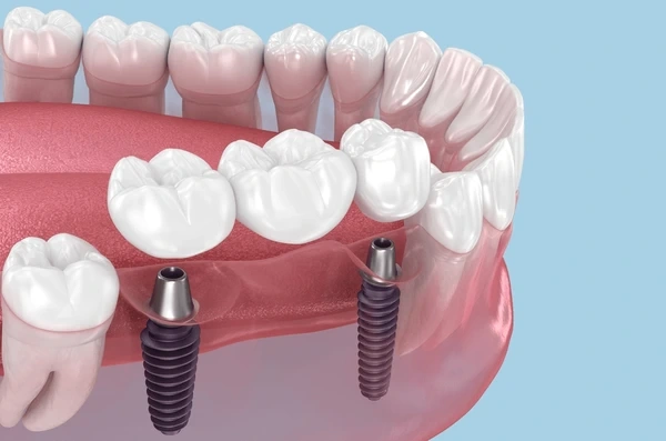 dental implant crowns in harmony, ab
