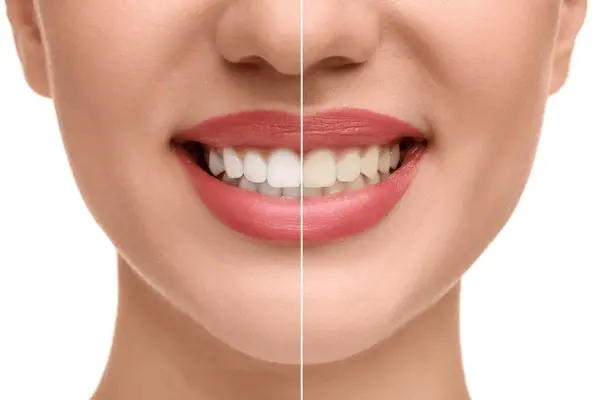 teeth whitening near you